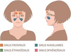 Ça fait mal sous vos yeux ? Ce sont les symptômes de la sinusite