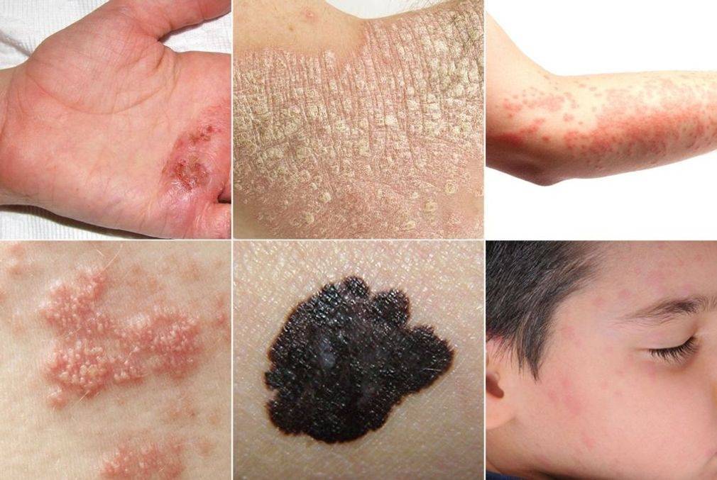 Différents types de psoriasis et symptômes