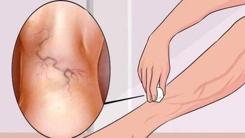 Ainsi, vous pouvez contrecarrer les varices avec l’exercice